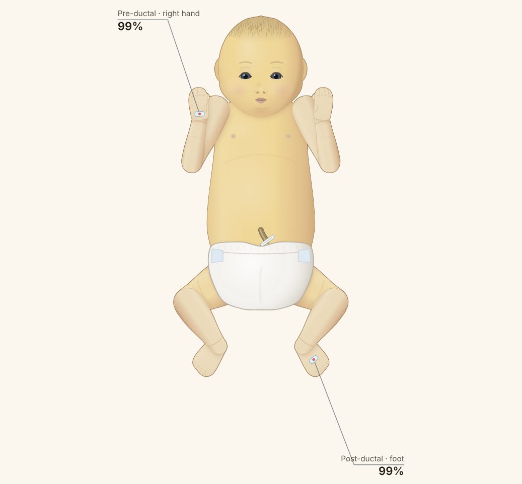 Cascade Neonatal model